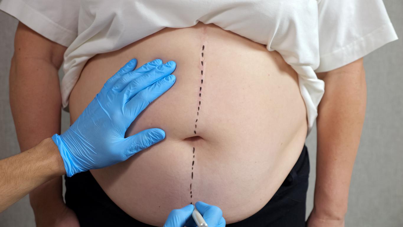 chirurgie bariatrique
