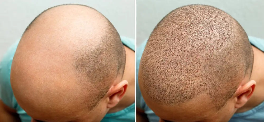 Greffe de cheveux