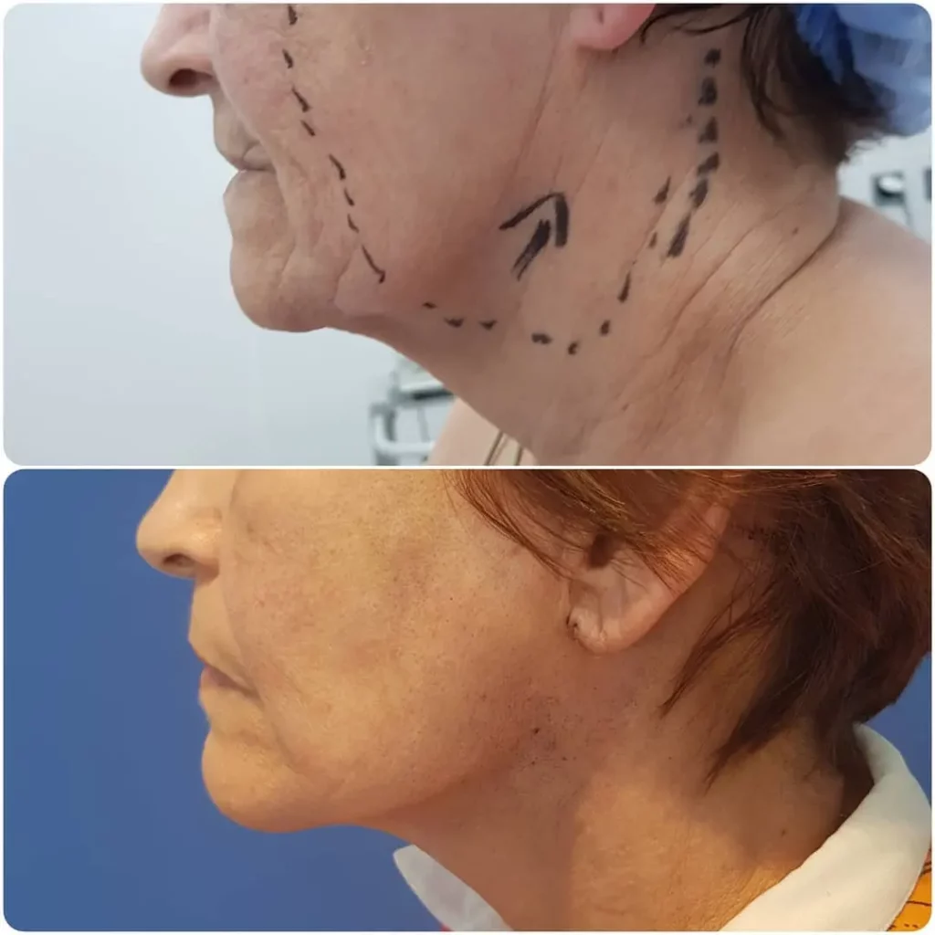 Lifting visage