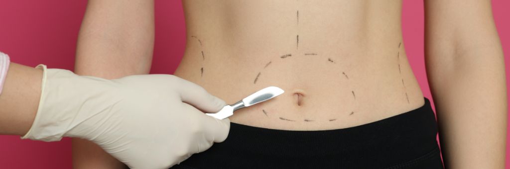 sleve vs bypass comparatif chirurgie bariatrique