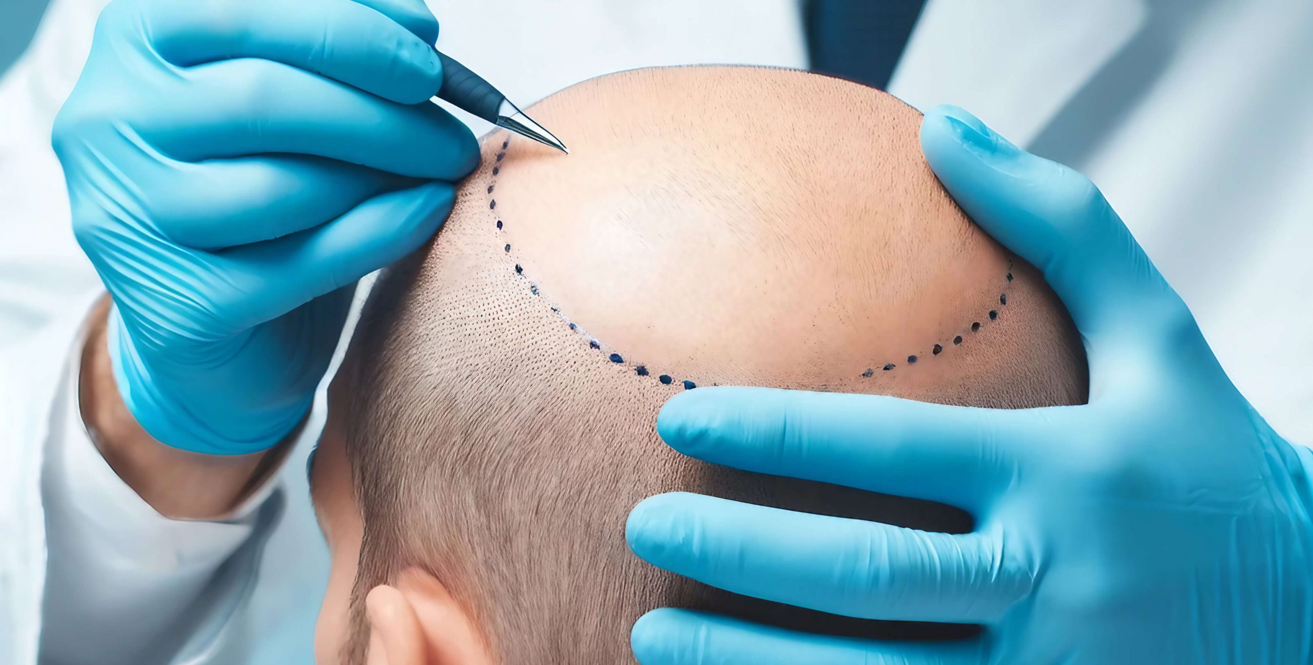 Comparatif prix : Tunisie vs Turquie pour la greffe de cheveux